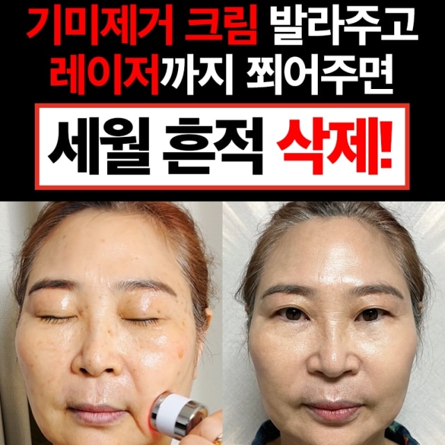 ★기미,검버섯 뿌리째 박멸★ 비타 리얼 토닝 레이저 크림